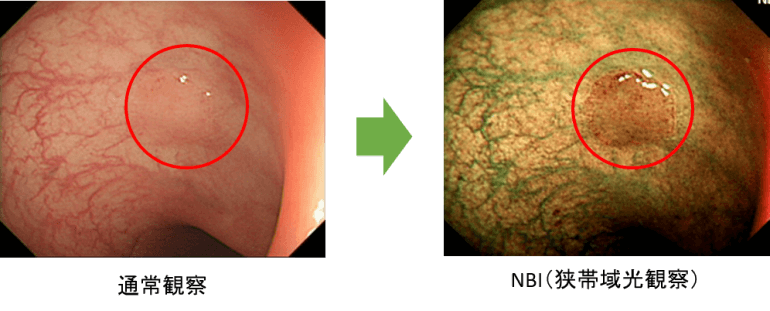 微細な病変を発見できる狭帯域光観察